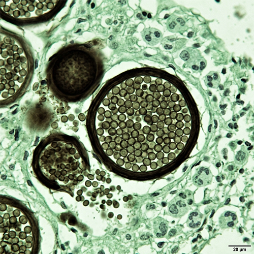 Fungal spores cause Valley Fever
